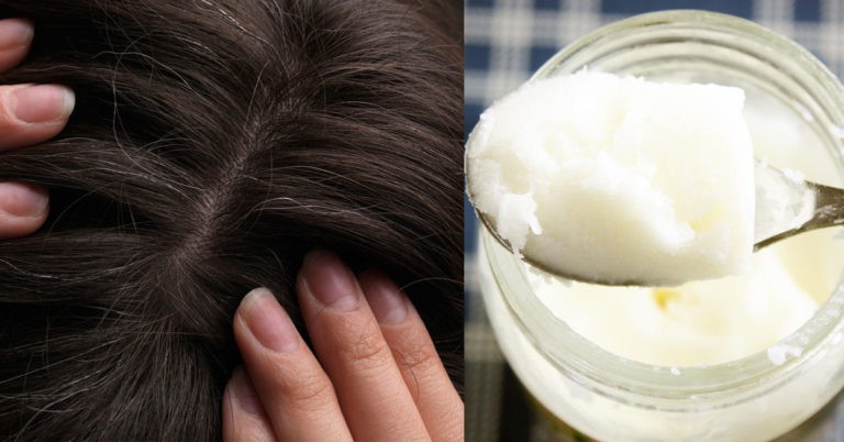 Как правильно применять кокосовое масло, чтобы устранить выпадение волос, перхоть и ускорить их рост
