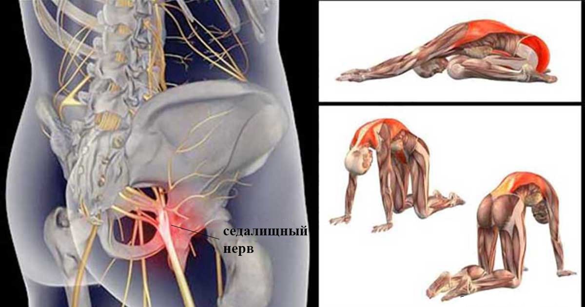 Как справиться с болью в спине при воспалении седалищного нерва? 11 лучших упражнений