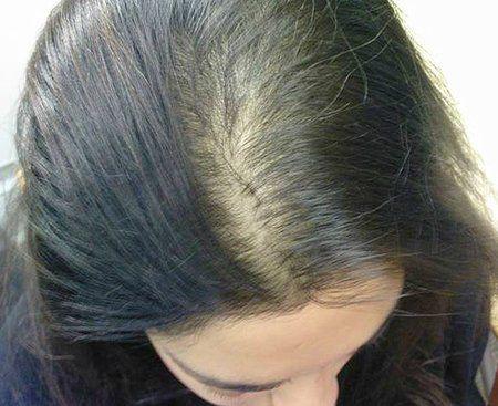 Как отрастить выпавшие волосы дома натуральным средством