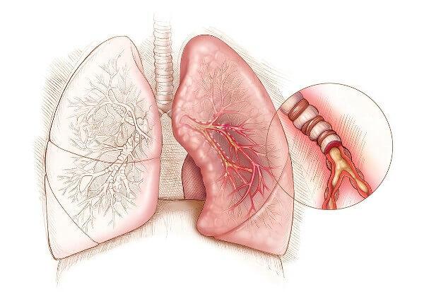 Как вывести мокроту и забыть про кашель: 5 натуральных отхаркивающих средства